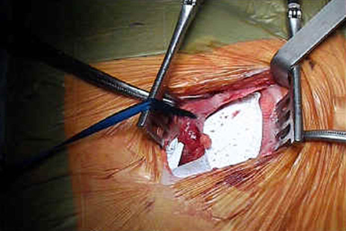 Hernie inguinale - Chirurgie par voie directe