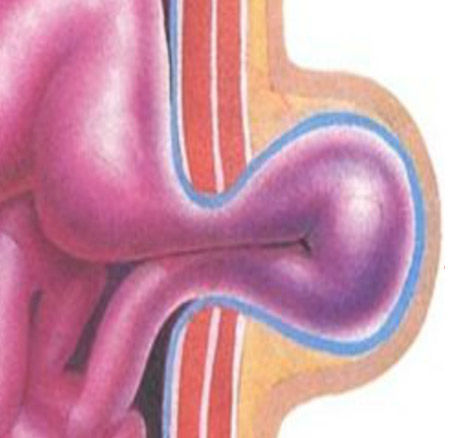 Piégeage intestinal - Hernie inguinale et de l'aine